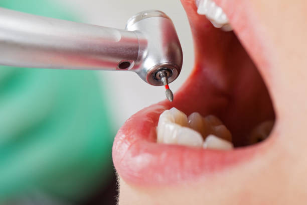 Best Emergency Tooth Extraction in Cologne, NJ